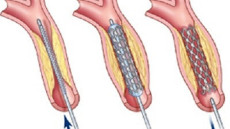 Tư vấn: Sau đặt stent mạch vành có phải tiếp tục uống thuốc không?